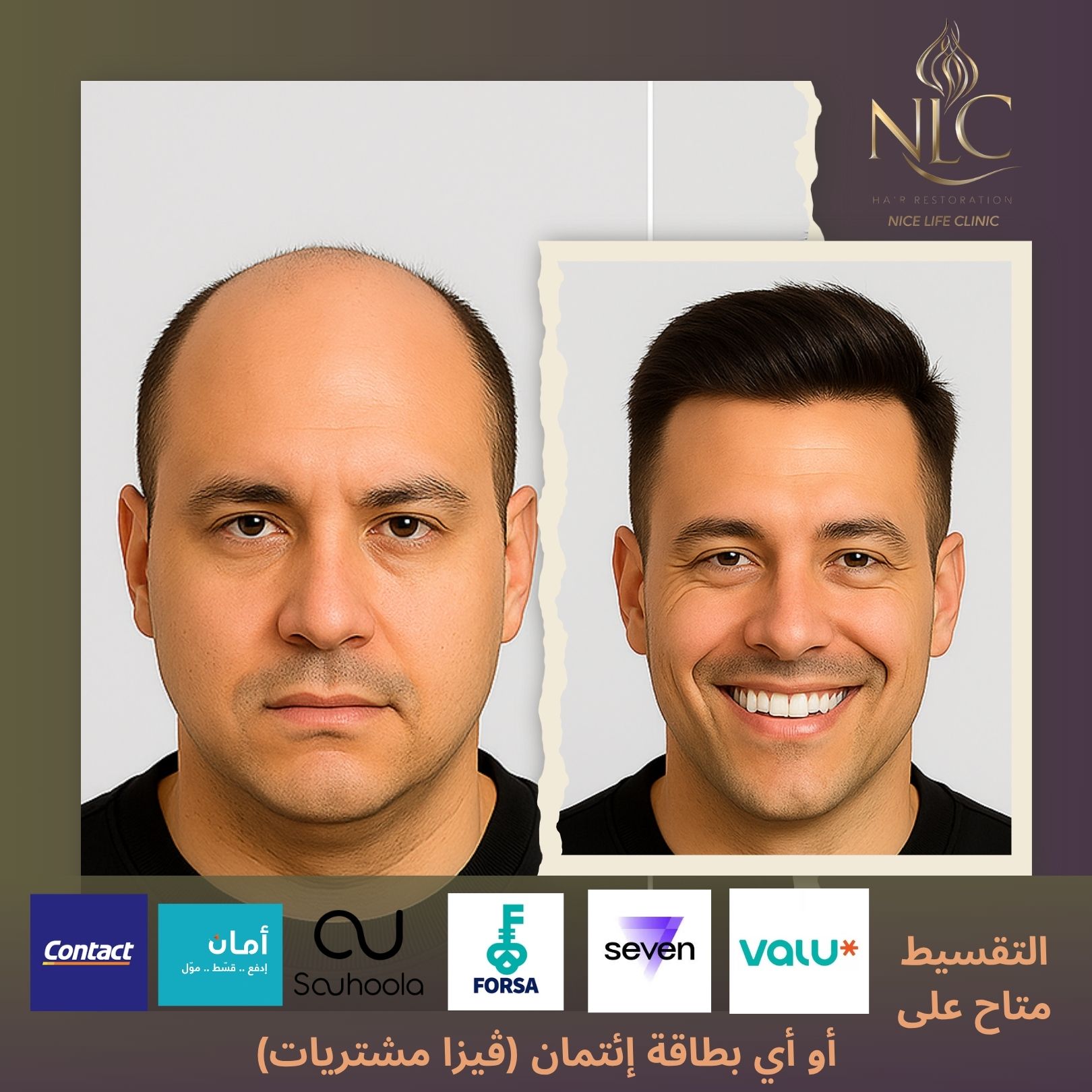 زراعة الشعر