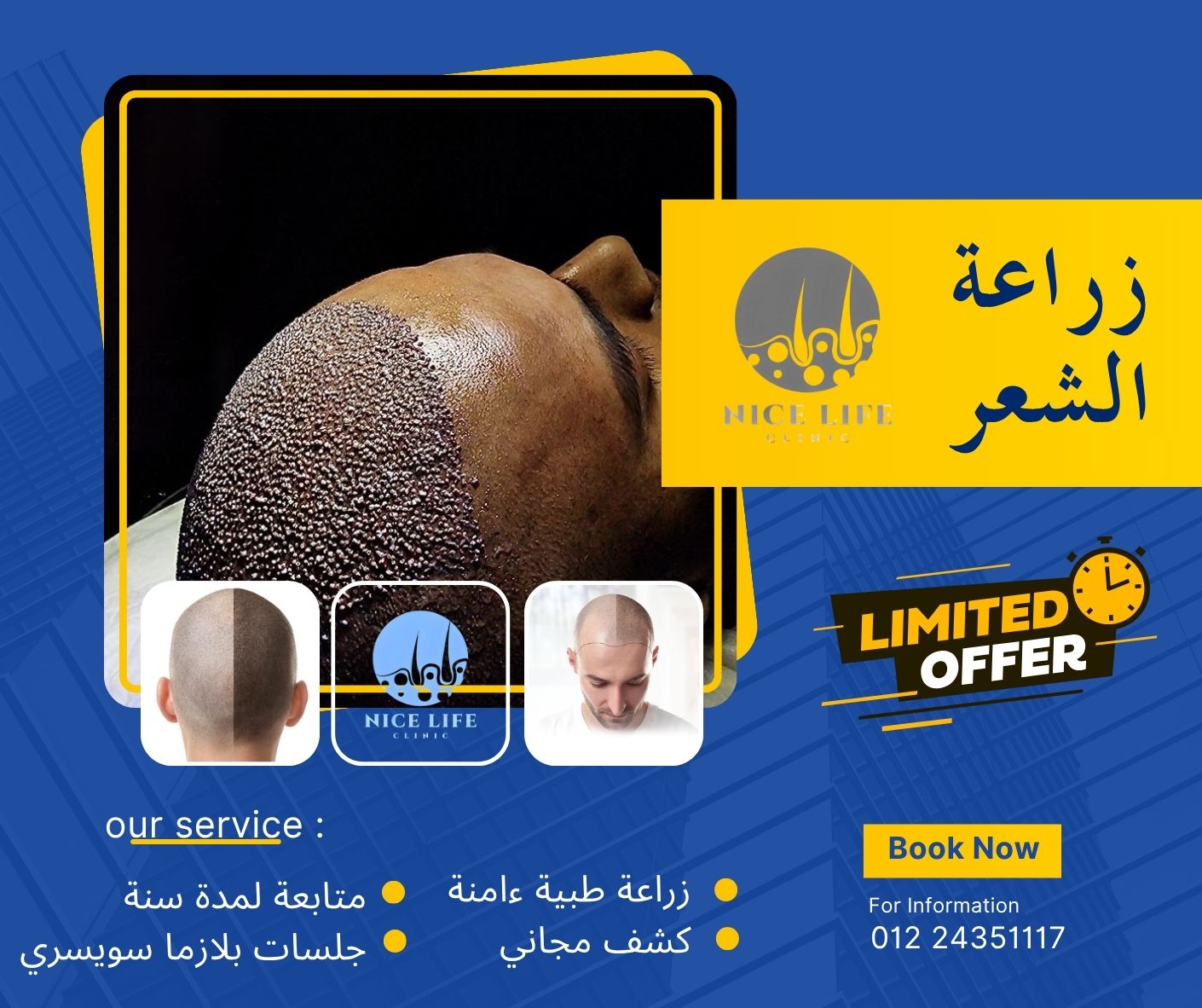 نتيجة عملية زراعة شعر 1
